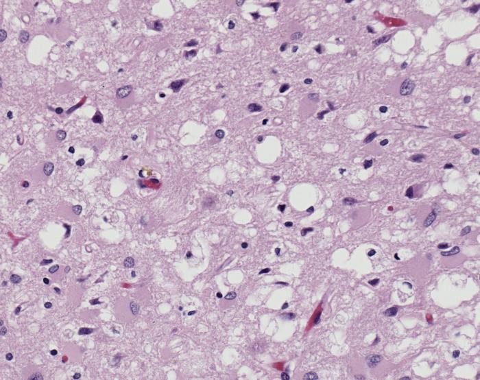 Photomicrograph of brain tissue stained with H&E reveals the presence of prominent spongiotic changes in the cortex, and loss of neurons in a case of variant Creutzfeldt-Jakob disease (100x mag). From Public Health Image Library (PHIL). [3]