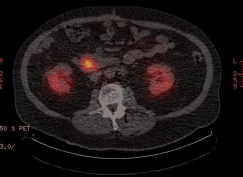 File:Neuroendocrine tumor pancreas 003.jpg