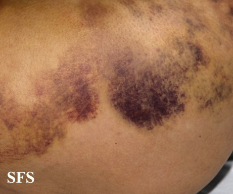 Painful bruising syndrome. Adapted from Dermatology Atlas.[5]