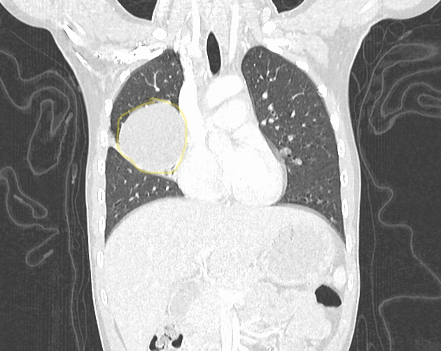 File:Coronal view of bronchogenic cyst.gif