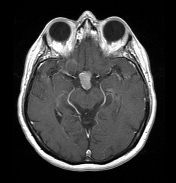 There is a well defined homogeneously enhancing lesion in the pituitary fossa on Axial T1 C+ suggestive of pituitary adenoma.[5]
