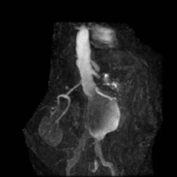 File:Renal artery stenosis 029.jpg