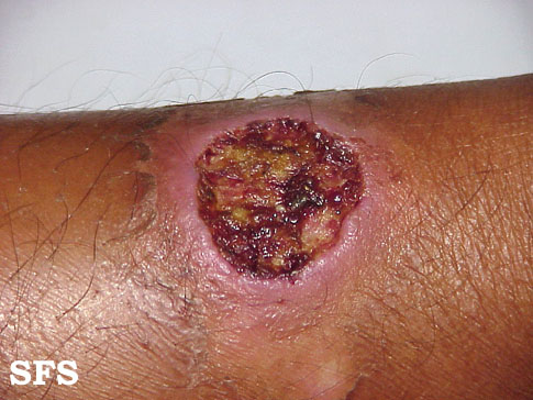 Tropical ulcer. Adapted from Dermatology Atlas.[6]