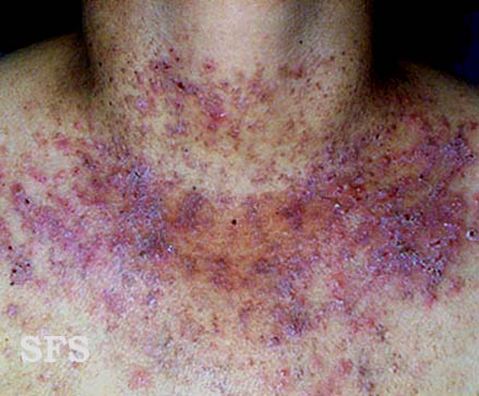 Darier's disease. Adapted from Dermatology Atlas.[1]