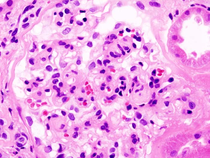 Histopathological image of diabetic glomerulosclerosis with nephrotic syndrome. Another glomerulus. H&E stain.