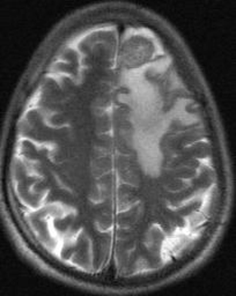 File:Intracranial-tuberculoma-mri-brain.jpg