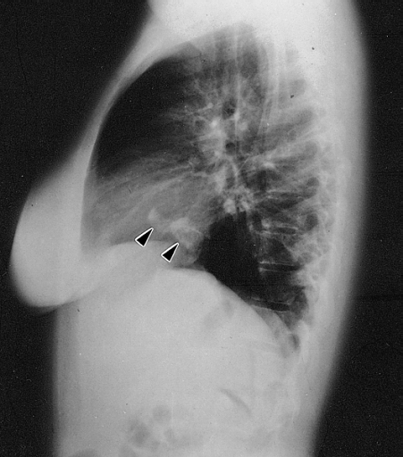 Lateral chest radiograph from a 16-year-old girl with syncope and bacterial endocarditis. The radiograph demonstrates two areas of dense calcification (arrowheads) overlying the posterior aspect of heart. The posterior-anterior (PA) view confirmed location in the heart (not shown). At surgery a calcified myxoma of the right atrium was removed. Image courtesy of Professor Peter Anderson DVM PhD and published with permission © PEIR, University of Alabama at Birmingham, Department of Pathology