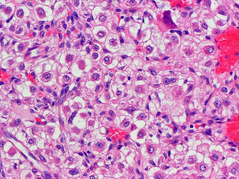 File:800px-Bone Chondrosarcoma ClearCell HP PA.jpg