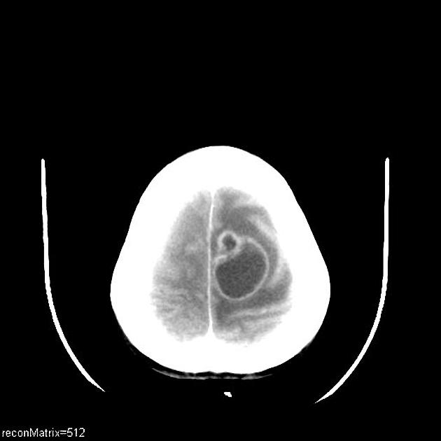 File:CT scan of brain metastasis 7 postcontrast.jpg