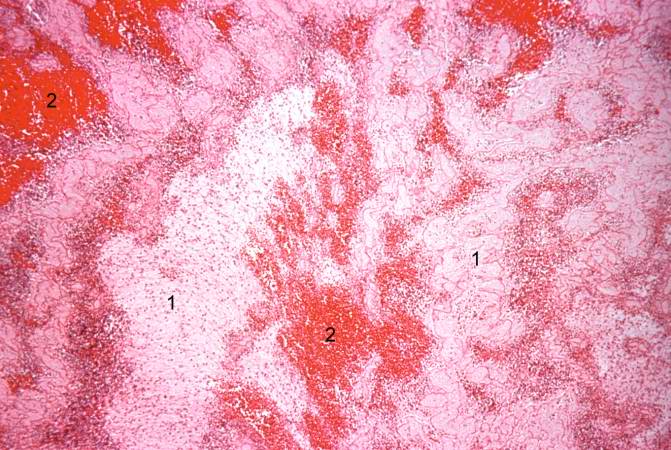 This is a higher-power photomicrograph of the thrombus. Note the pale regions which contain primarily platelets (degranulated platelets) with some fibrin (1), and the red areas which contain RBCs, some leukocytes, and fibrin(2).