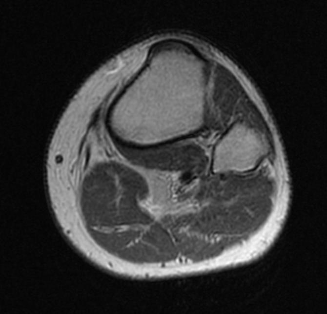 File:Plantaris rupture MRI 001.jpg