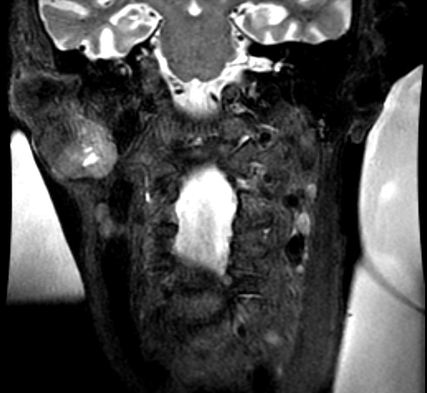 MRI: A right parotid pleomorphic adenoma