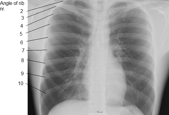 X-ray image of human chest, with ribs labeled.
