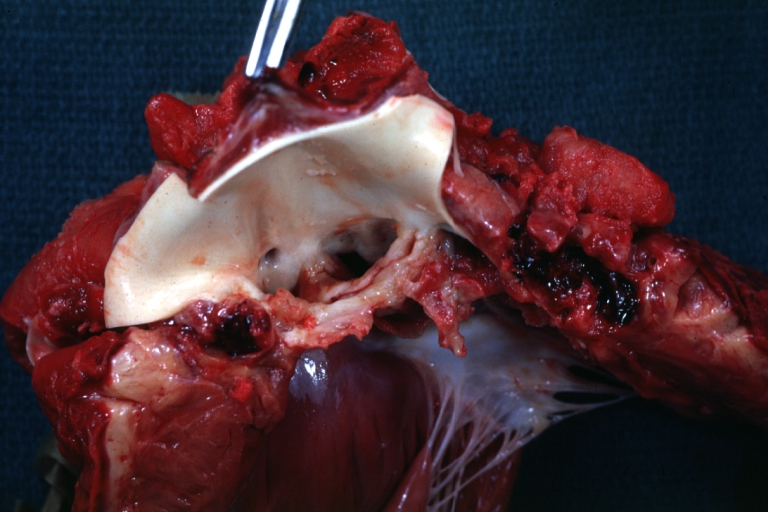 Sinus of Valsalva Aneurysm: Gross; difficult to orient but aneurysm is visible.