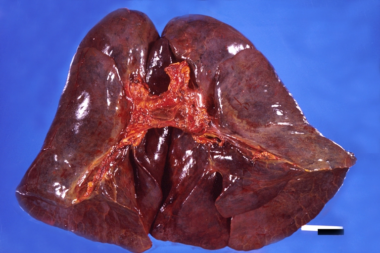 Lung, hemorrhagic bronchopneumonia, Wilson's disease