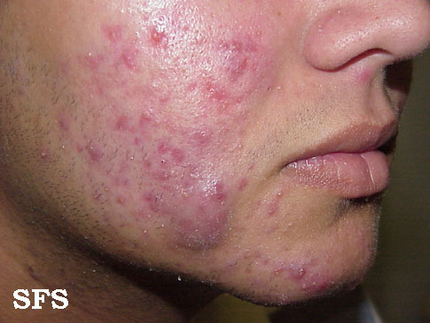Acne vulgaris. Adapted from [http://www.atlasdermatologico.com.br/disease.jsf?diseaseId=3