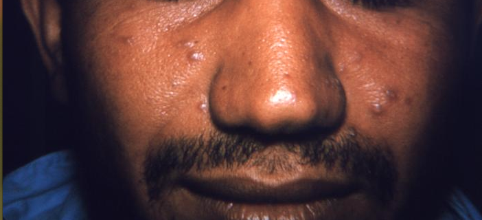 Maculopapular lesions on the face of a Brazilian smallpox patient. From Public Health Image Library (PHIL). [5]
