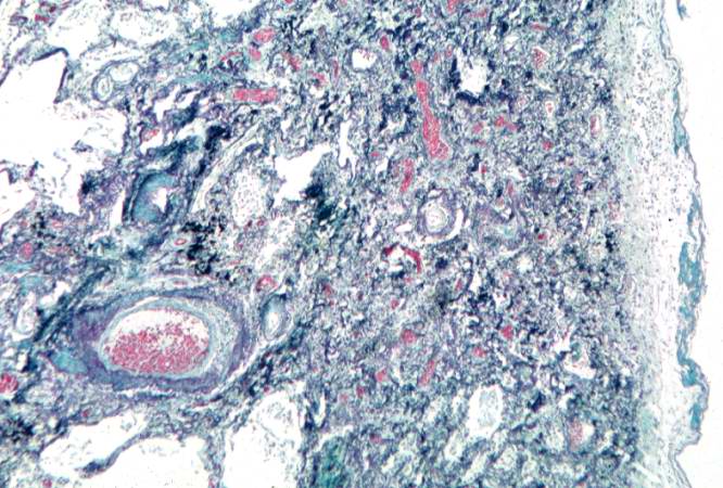 This is a photomicrograph of a trichrome-stained section of lung demonstrating the extensive fibrosis throughout this section (green-blue stained material is fibrous connective tissue).