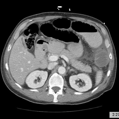 Small bowel obstruction Image courtesy of RadsWiki and copylefted