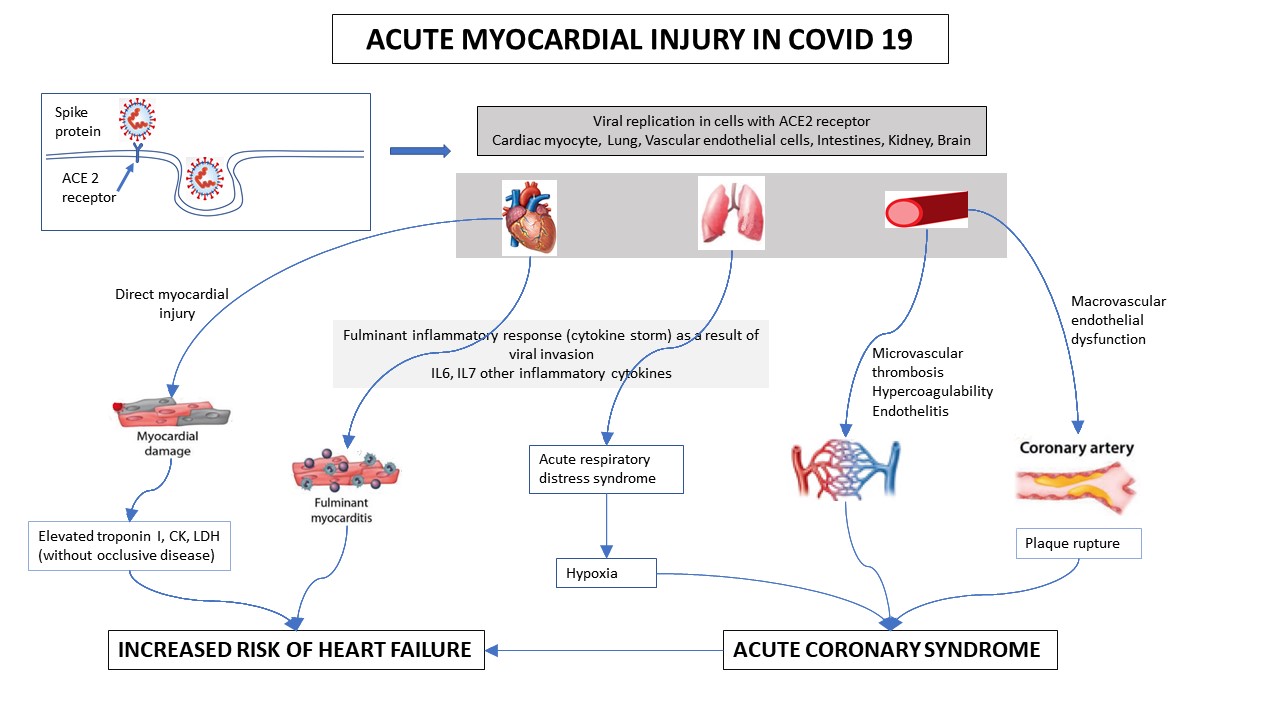 File:Acute myocardial injury in COVID19.jpg