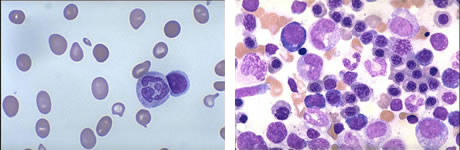 B12 anemia (pernicious), megaloblastic anemia, hypersegs.jpg