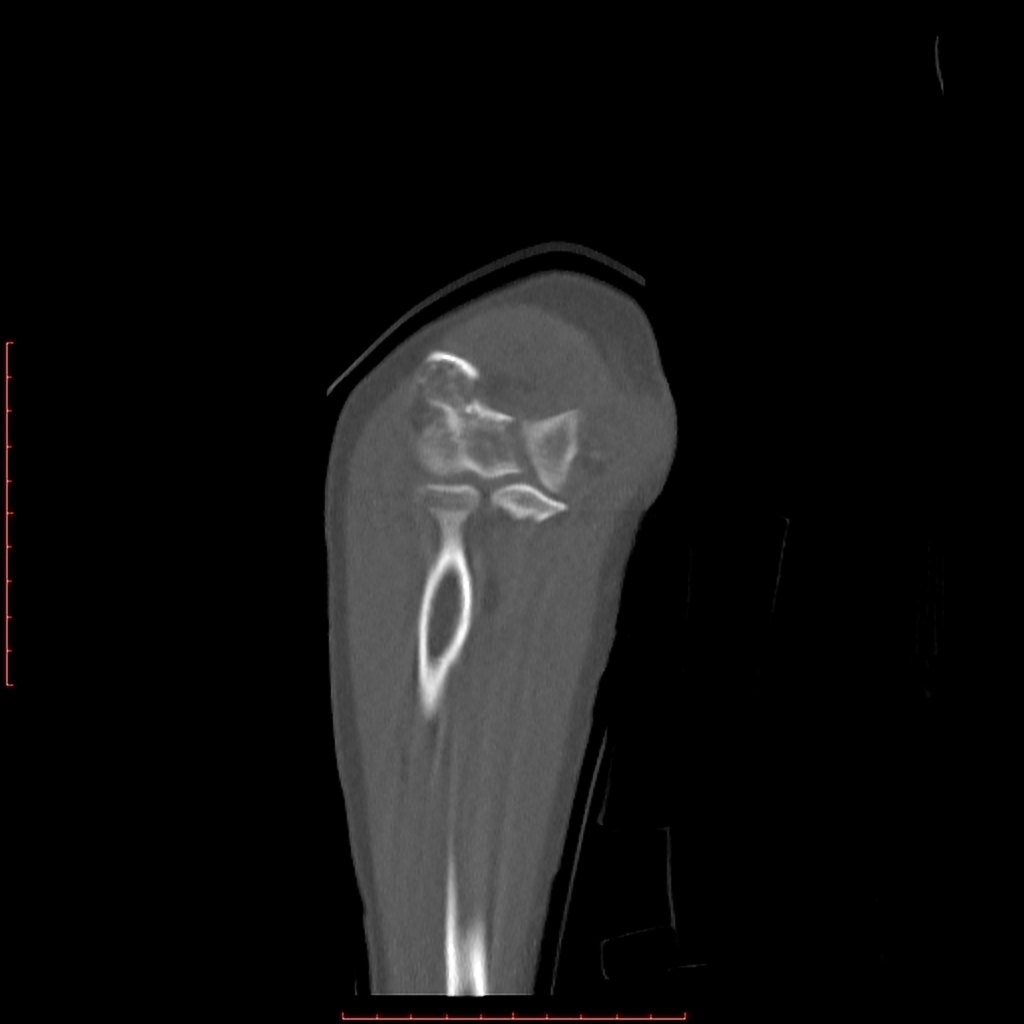 Comminuted T- condylar fracture of the left distal humerus is noted with intra-articular extension. Posterior displacement of the distal fragment is seen in the sagittal plane; with mild lateral/valgus displacement and rotation is noted in the coronal plane. No radial or ulnar fracture is noted.Soft tissue swelling is noted around the elbow. Mild joint effusion with likely lipohemarthrosis.