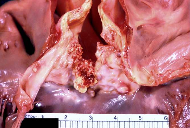 This gross photograph affords a closer view of the same aortic valve. Note the nodularity and thickening of this valve due to fibrosis and dystrophic calcification.