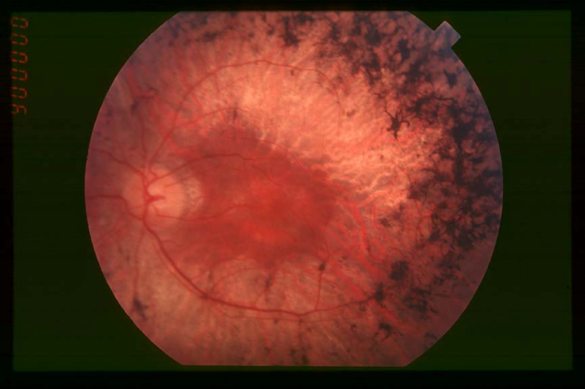 Fundus of patient with retinitis pigmentosa, mid stage.jpg