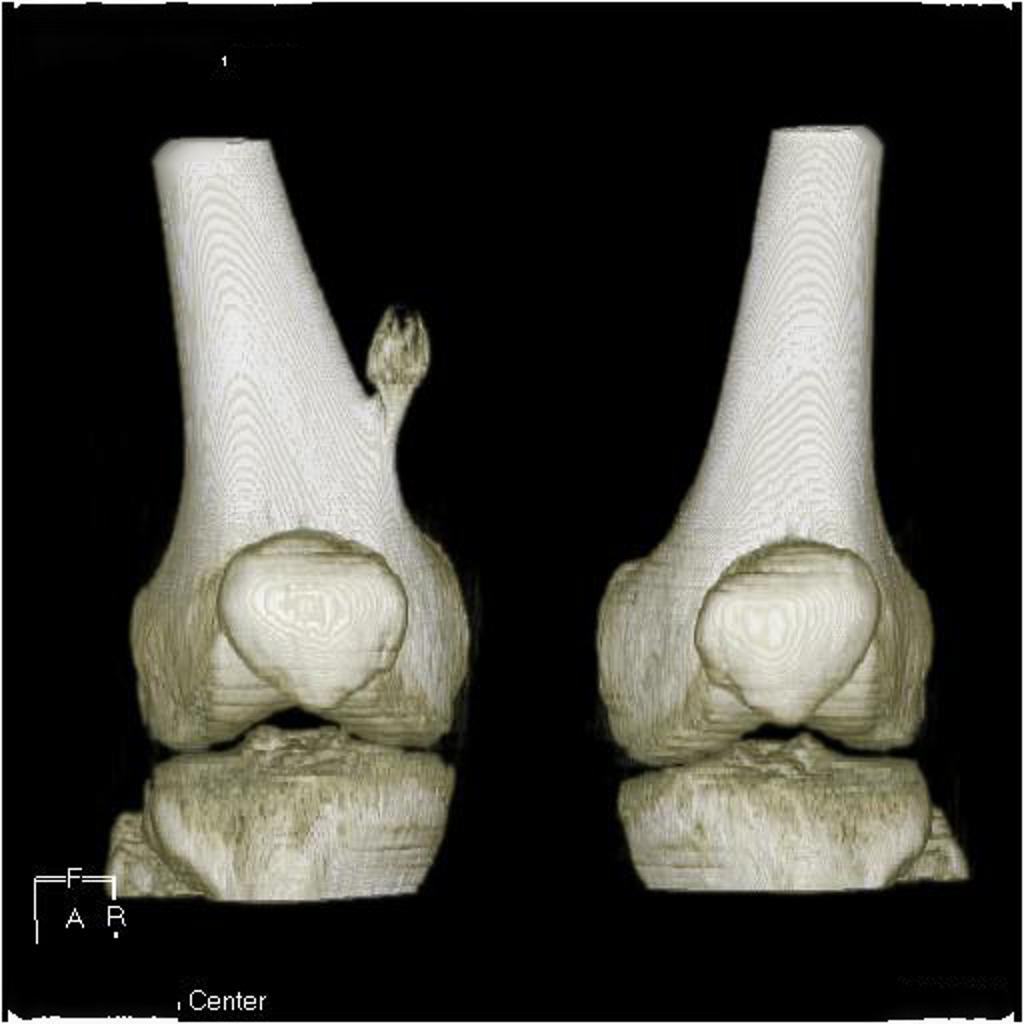 Volume rendered CT : femur osteochondroma