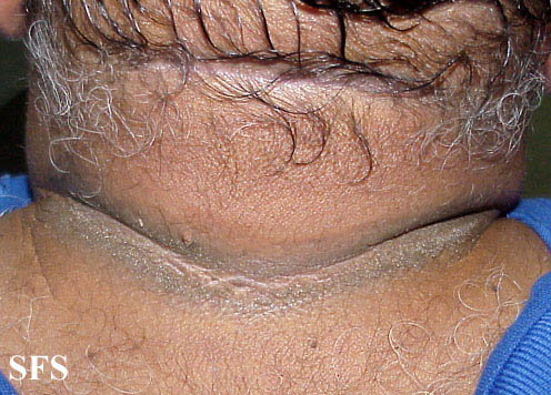 Pseudo acanthosis nigricans. Adapted from Dermatology Atlas.[2]