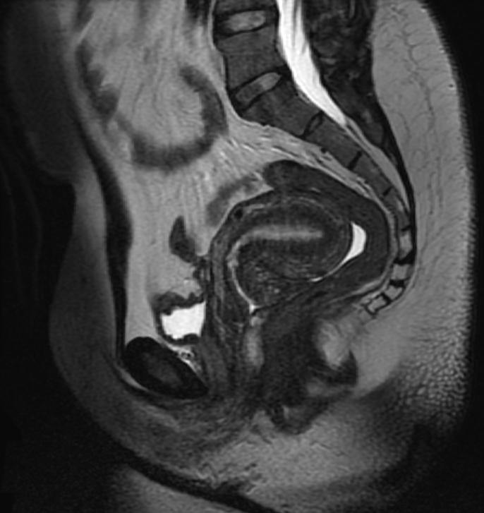 File:Retroverted uterus MRI 002.jpg