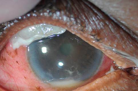 Hyperemic conjunctiva, opacified bleb with purulent adherent material, hypopyon, and fibrinous AC reaction.
