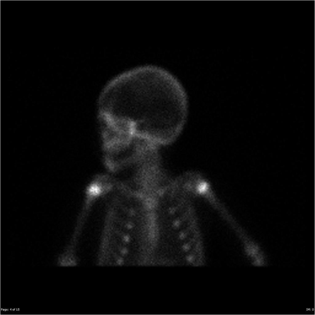 File:Burkitt's lymphoma bone scan 02.jpg