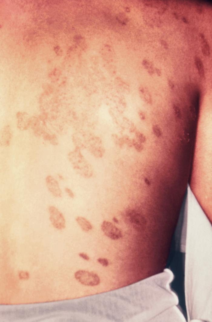 Lesions that were diagnosed as ringworm, attributed to a dermatophytic fungal organism, Trichophyton verrucosum. From Public Health Image Library (PHIL). [1]