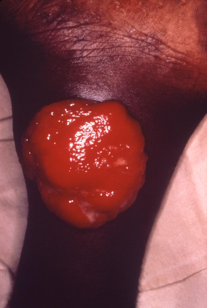 This patient presented with a case of systemically disseminated Donovanosis of the ankle due to C. granulomatis bacteria. From Public Health Image Library (PHIL). [4]