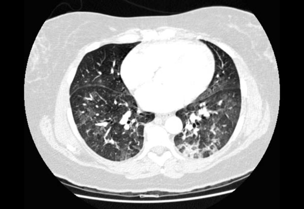 File:Pulmonary-oedema-3.jpg