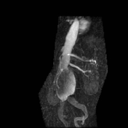 File:Renal artery stenosis 028.jpg
