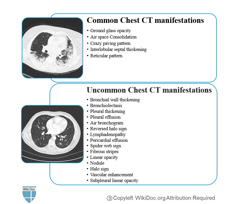 File:CT-FINDINGS-COVID-19.PNG