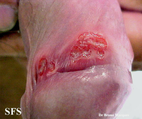 Chancroid. Adapted from Dermatology Atlas.[4]