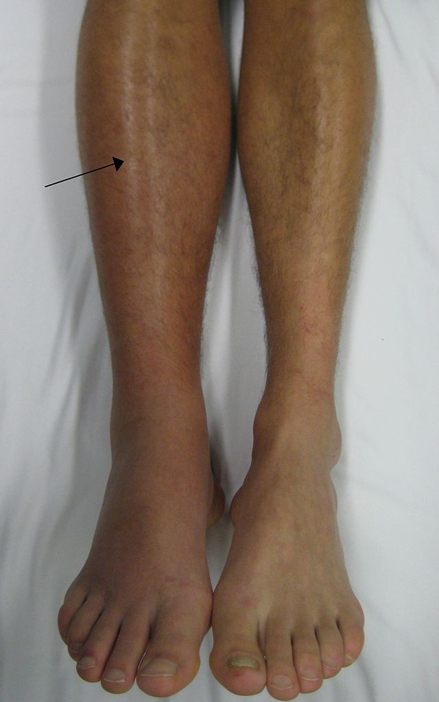 File:Deep vein thrombosis Unilateral leg swelling and redness.jpg
