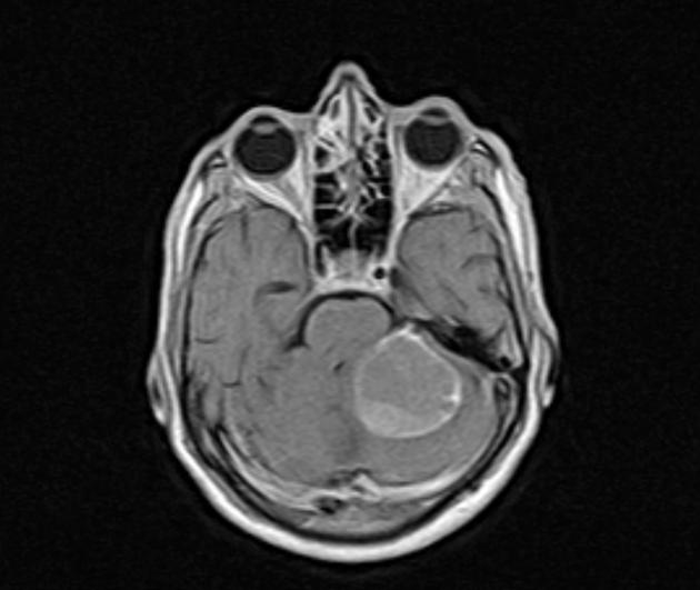 Axial T1-weighted MRI head with contrast of a 58 year old middle eastern male with pancoast tumor (adenocarcinoma), complaining of headache, vomiting, and syncopal attacks, demonstrates left cerebellar cystic lesion with fluid level with T1 hyperintense signal, likely hemorrhage. They show rim enhancement after contrast and surrounded by brain edema exerting mass effect upon the left lateral ventricle and left aspect of pons.[11]