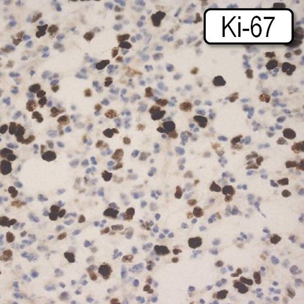 Histology of oligoastrocytoma cells demonstrating positivity to tumor marker Ki-67.[23]