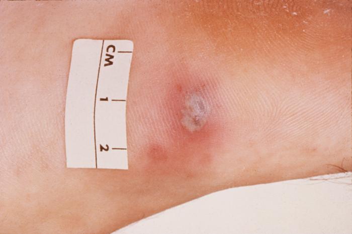 This is a photograph of a skin lesion on a patient diagnosed with gonorrhea.Gonorrhea, caused by Neisseria gonorrhoeae, if left untreated will enter the blood, thereby, spreading throughout the body. As is shown here, such full body dissemination may manifest itself as skin lesions throughout the body.Adapted from CDC