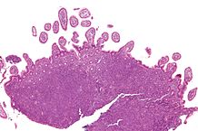 File:218px-Mantle cell lymphoma - low mag.jpg