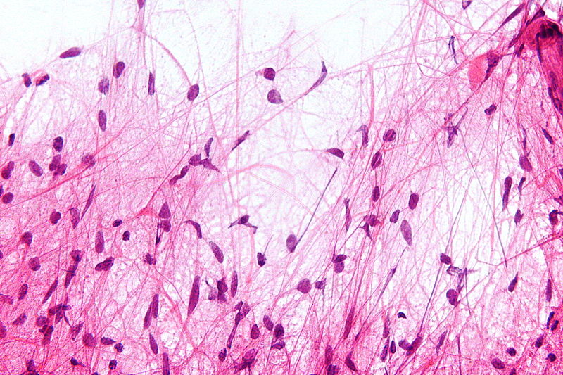 File:800px-Pilocytic astrocytoma - smear - very high mag.jpg