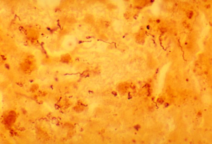Histopathology showing Borrelia burgdorferi spirochetes in Lyme disease. - Source: Public Health Image Library (PHIL). [22]