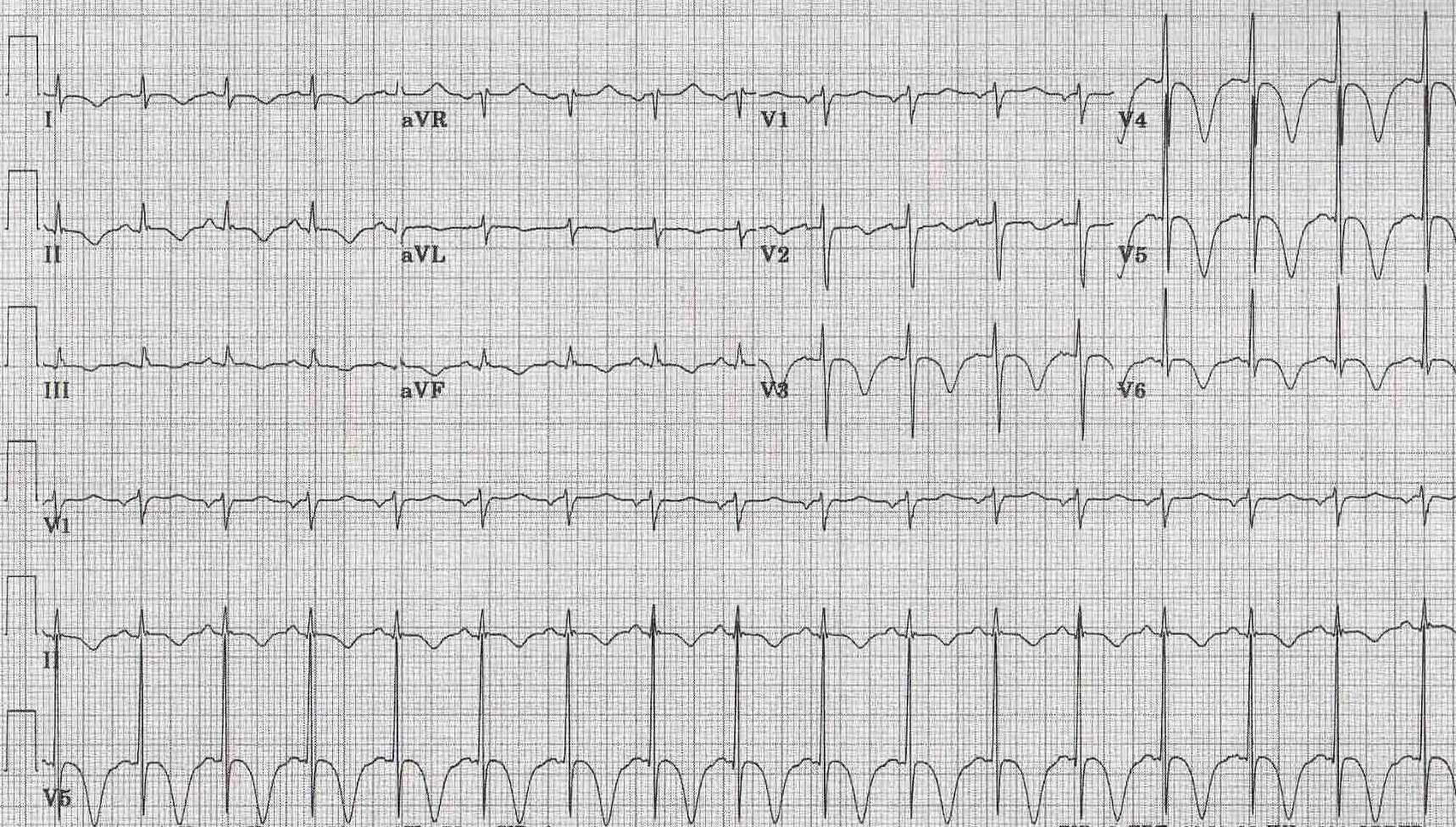 EKG of a patients with CNS Disorders