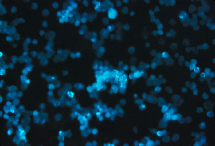 A photomicrograph of leukemia cells using Direct Fluorescent Antibody staining technique (DFA).[2]