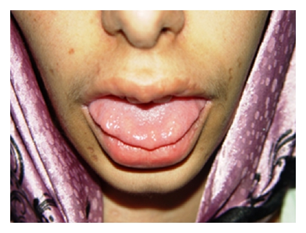 The patient had mucosal neuromas on the anterior third of her tongue. Note the bumpy/blubbery lips., From the case [1]