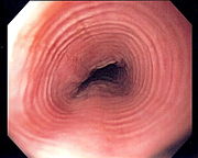 Multi ring esophagus.jpg